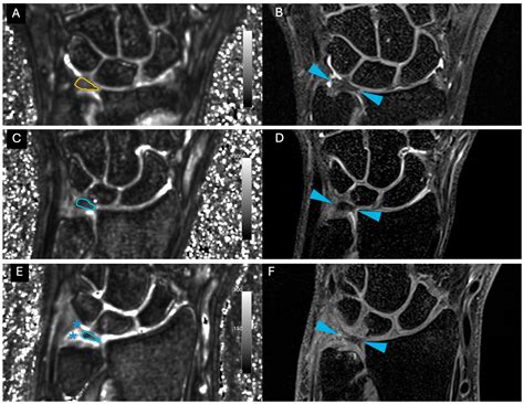 Triangular Fibrocartilage Characterization with Ultrashort Echo Time-T2 ...