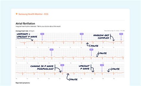 Premature Atrial Contraction (Single) Vs. Premature Atrial Contraction (Multiple) on Your Watch ...