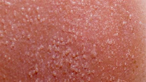 Bumps On Skin After Sun Exposure Treatment at Joseph Dearth blog