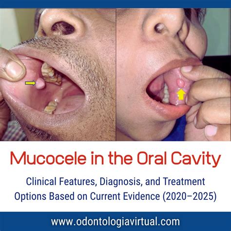 Mucocele in the Oral Cavity: Clinical Features, Diagnosis, and Treatment Options Based on ...