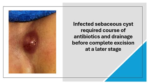 Image result for Abscessed Cysts Exploding