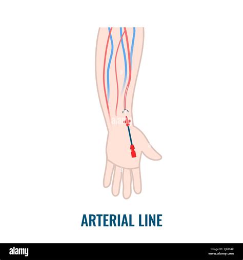 Arterial line catheter, illustration Stock Photo - Alamy