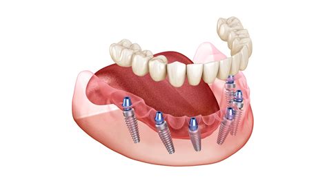 All-on-6 Dental Implant – Star Dental