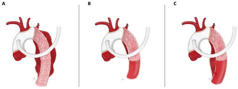 Contemporary Single-Center Experience of Complete Aortic Arch Replacement Employing the Frozen ...