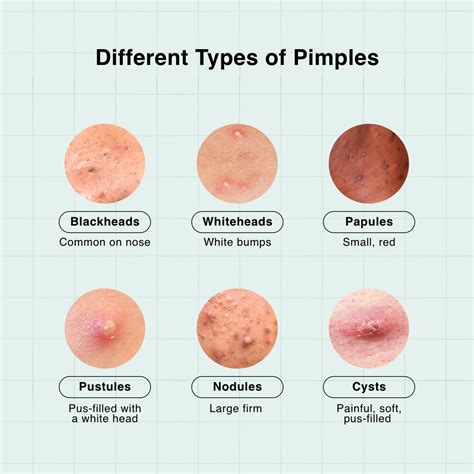 Pimples on forehead: What are the Causes & Treatments?