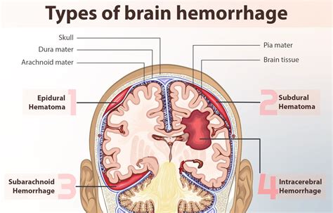 Epideral & Subdural Hematoma — BrainInjury.com