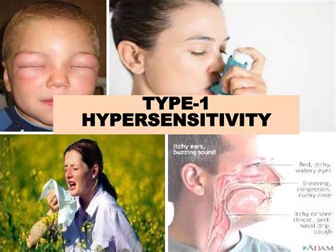 Type 1 hypersensitivity | PPTX