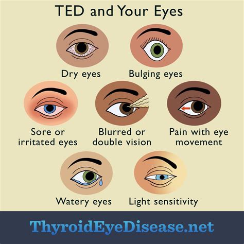 What Is Ted Eye Disease