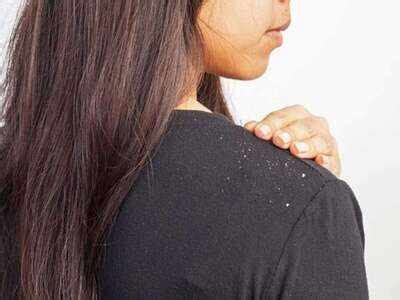 Tea tree oil hair conditioner to fight dandruff and itchy scalp - The ...