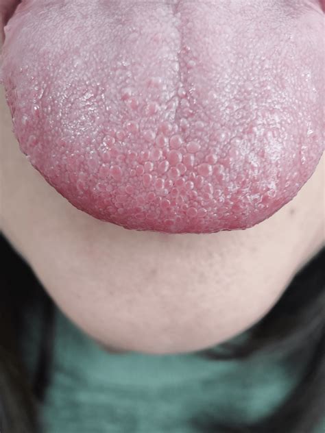 Swollen Taste Bud On Tongue