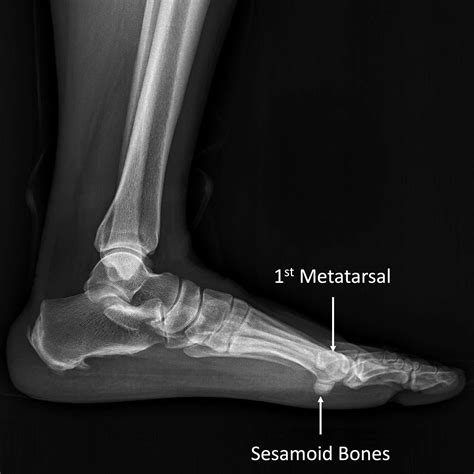 Sesamoid Bone Big Toe Ball Of Foot Pain at Mary Loper blog