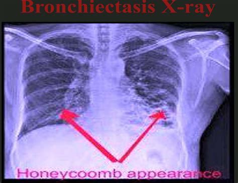 Chest X-Ray Showing Bronchiectasis at Ronald Delancey blog