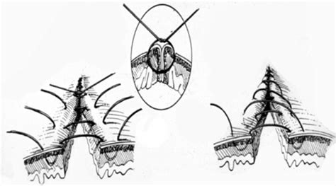 Image result for Common Suture Patterns