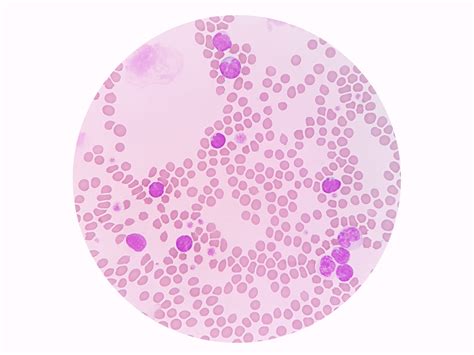 Lymphocytosis (High Lymphocyte Count)-Causes, Symptoms & Treatment