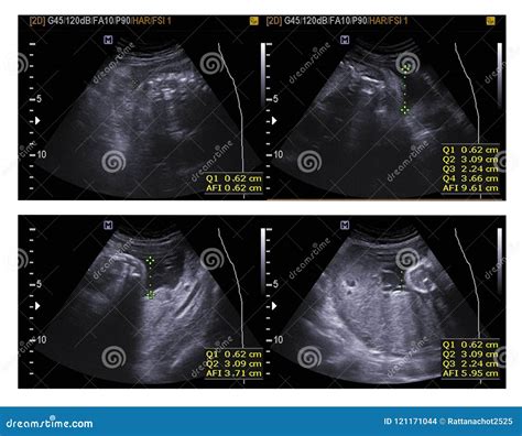 How To Read Ultrasound Of Abdomen at Holly Brough blog