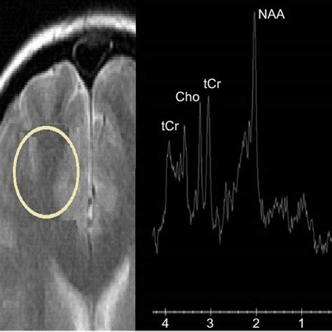 Image result for Dorsolateral Prefrontal Cortex