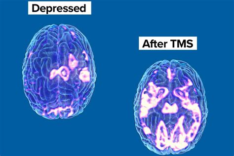 Transcranial Magnetic Stimulation - HeadworX Clinic