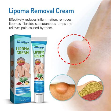 lipoma cream benjolan ubat benjolan lipoma removal cream Removal Multiple Single Lipoma ...
