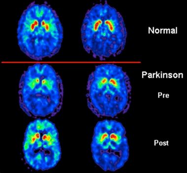 Rezultat imagine pentru Dat Brain Scan