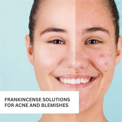 Frankincense Oil in Modern Skincare | Clinikally