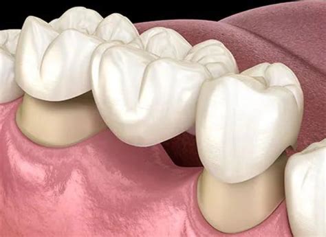 RKSMILEARTZ | +919880406336 | Dental, veneers Banaswadi, Invisalign ...