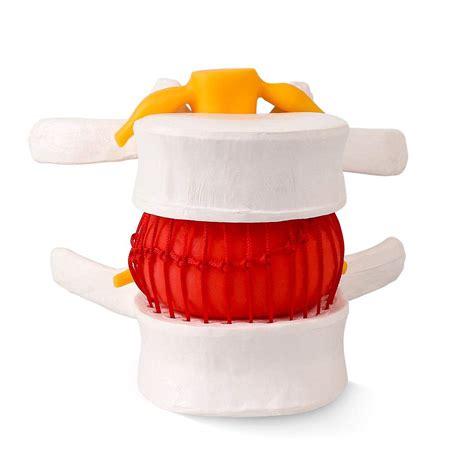YOOVEE Anatomical Lumbar Disc Herniation Model - Ideal for India | Ubuy
