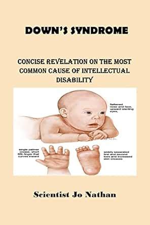 DOWN SYNDROME: Concise Revelation on The Most Common Cause of ...
