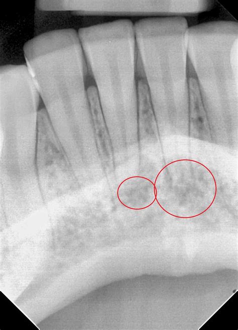 Root Canal Front Bottom Tooth