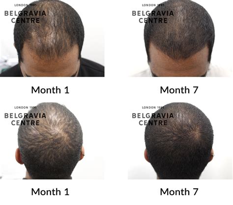 How To Fix Uneven Hair Growth Black Male at Ellie Roseby blog