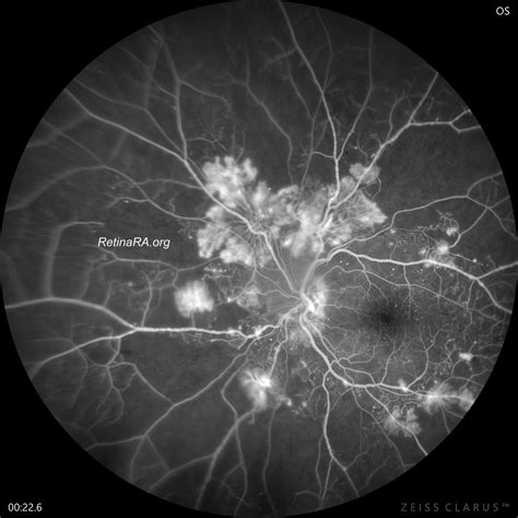 Proliferative Diabetic Retinopathy - RetinaRA