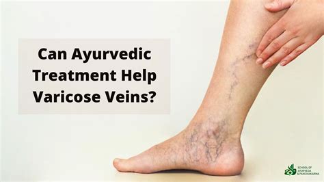 Looking Good Info About How To Help Varicose Veins - Dugdrive82