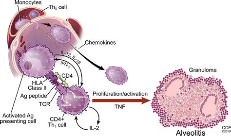 Sarcoidosis - Immunology and Allergy Clinics