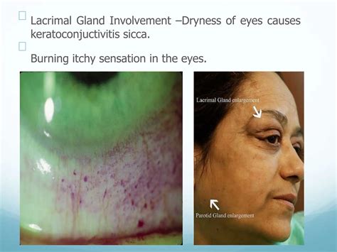 sjogren's syndrome clinical features,diagnosis,management | PPTX
