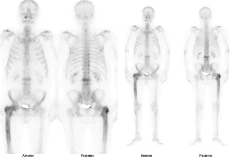 Enfermedad ósea de Paget: 1877-2023. Etiología y abordaje de una ...