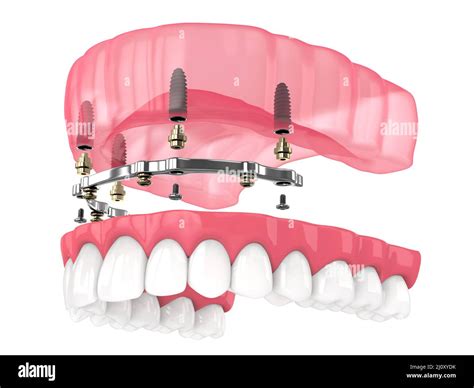 Implant Supported Removable Denture at Garrett Kirk blog