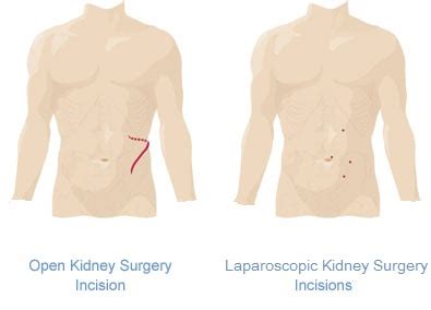 Image result for Hal Nephrectomy