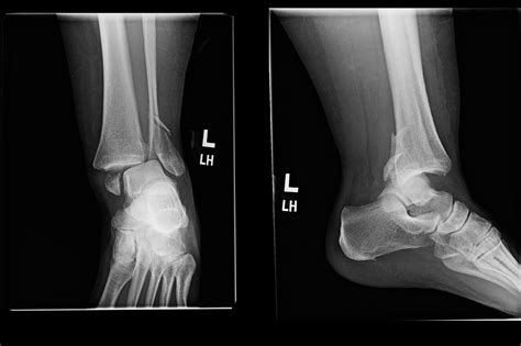 Xray Broken Ankle