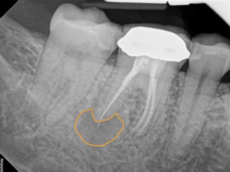 Root Canal Abscess X Ray at Clifford Rains blog