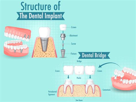 Dental Bridge Cost BEST Dental Bridges Royal Palm Beach FL Dental