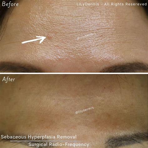 Sebaceous Hyperplasia Treatment