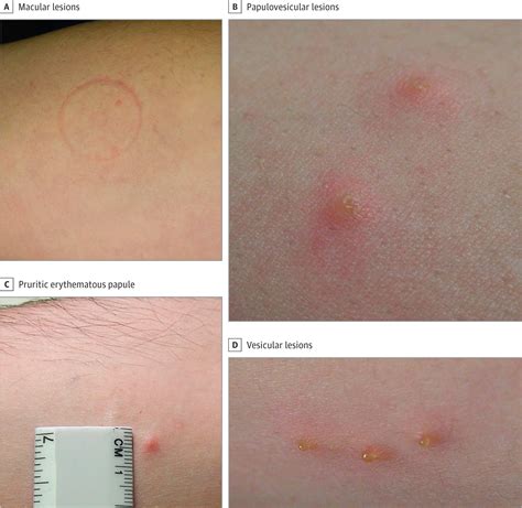 Cutaneous Lesions Due to Bites by Lone Star Ticks | Allergy and ...