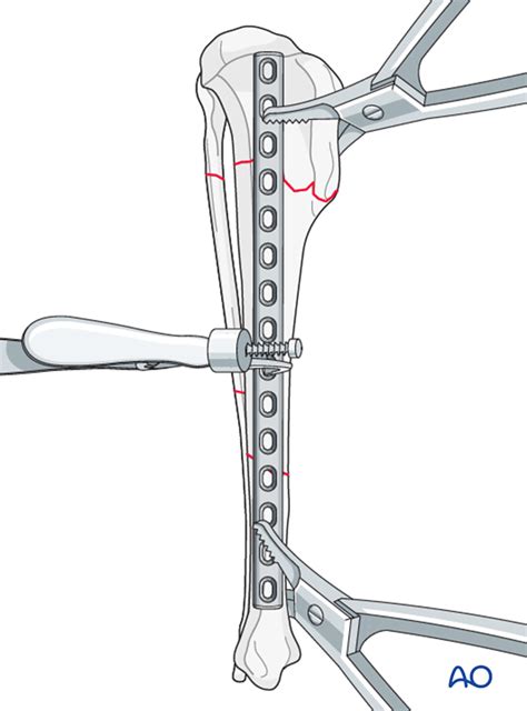 Compression Plate Ao 的图像结果