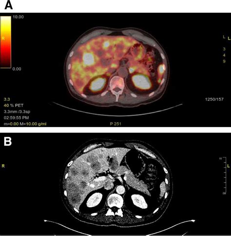 Somatostatin Receptor Expression in Lung Neuroendocrine Tumors: An Analysis of DOTATATE PET ...