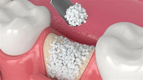 How Does A Bone Graft Work After Tooth Extraction at Allen Heffernan blog