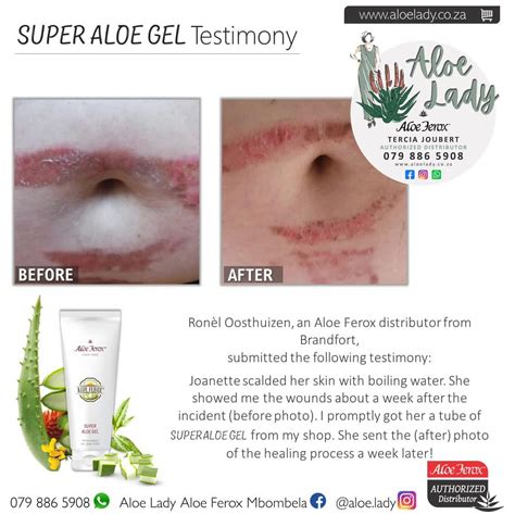 Super Aloe Gel Testimony - Burn relief | Aloe Lady