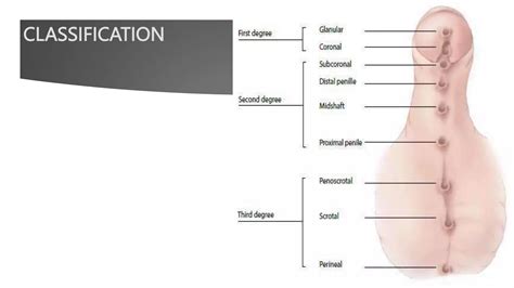 HYPOSPADIAS & EPISPADIAS.pptx