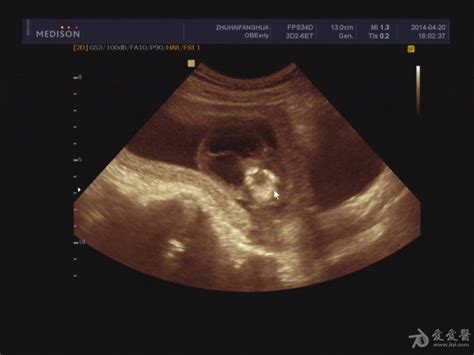 孕17周死胎头背部水囊 - 超声医学讨论版 - 爱爱医医学论坛