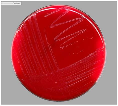 The First Lethal Infection by Oligella ureolytica: A Case Report and ...