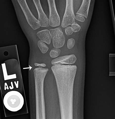 Bones out of place? Wrist fractures - Clinical Tree