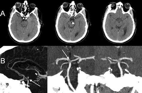 Basilar Artery Stroke